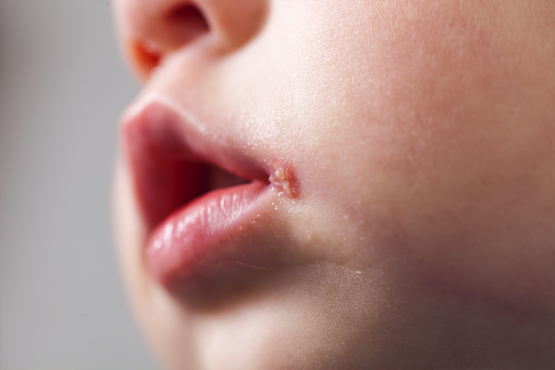 Cách phòng tránh trẻ bị nhiễm virus herpes?
