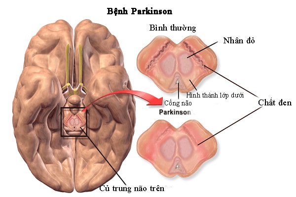 Nguyên nhân gây bệnh Parkinson
