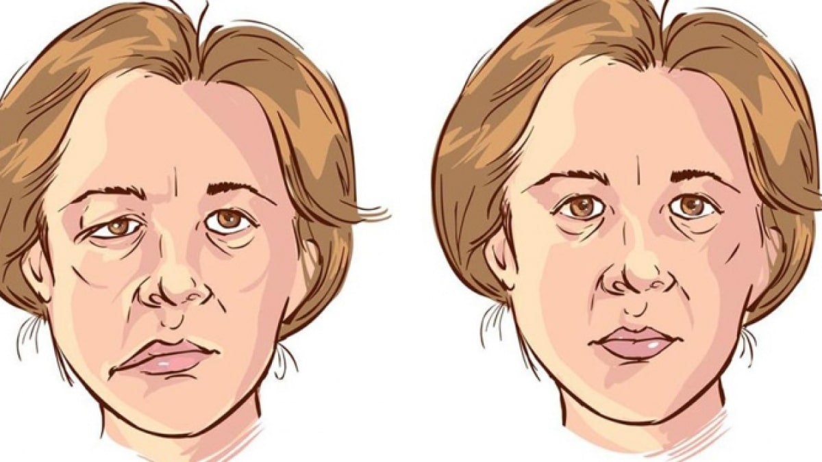 Liệt mặt do thời tiết lạnh đột ngột