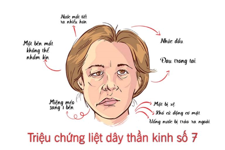 Dấu hiệu bị liệt mặt