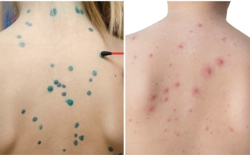 Điều trị bệnh thủy đậu