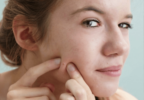 c&aacute;ch trị mụn li ti tại nh&agrave;