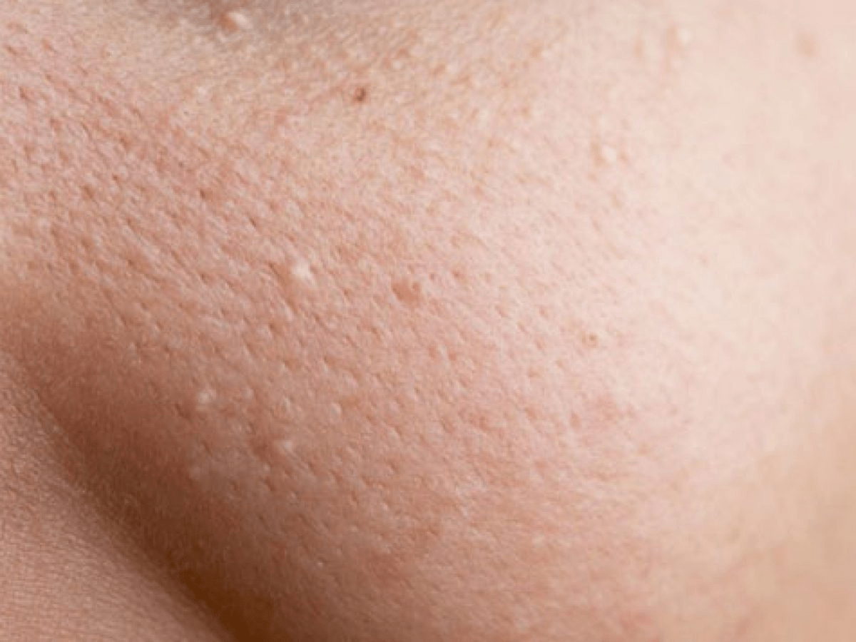 Nổi mụn trắng nhỏ kh&ocirc;ng ngứa tr&ecirc;n mặt