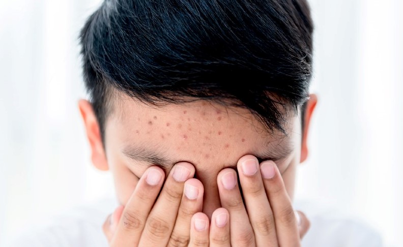 Mụn trứng c&aacute; kh&ocirc;ng chỉ ảnh hưởng tới da m&agrave; c&ograve;n c&oacute; t&aacute;c động ti&ecirc;u cực tới t&acirc;m l&yacute;