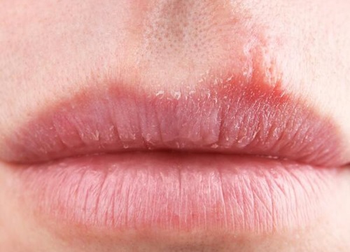 Hạt fordyce thường xuất hiện ở m&ocirc;i g&acirc;y mất thẩm mỹ