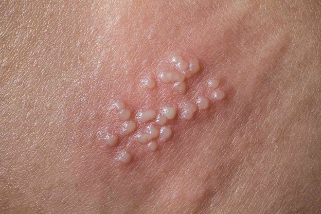 H&igrave;nh ảnh hạt fordyce ở v&ugrave;ng k&iacute;n