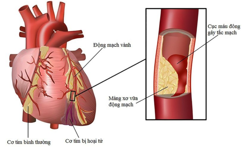 Nhồi máu cơ tim là tình trạng tắc hẹp động mạch nuôi tim